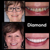 Resultat Diamond Smile tannbleking fargekorrigerende skum - Før bilde Etter bilde av hvite tenner
