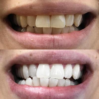 Teeth whitening for white teeth. On the picture a before and after picture of teeth after teeth whitening.