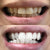 Teeth whitening for white teeth. On the picture a before and after picture of teeth after teeth whitening.