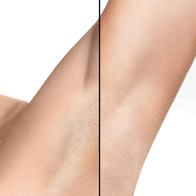 IPL hårfjerning Lumi