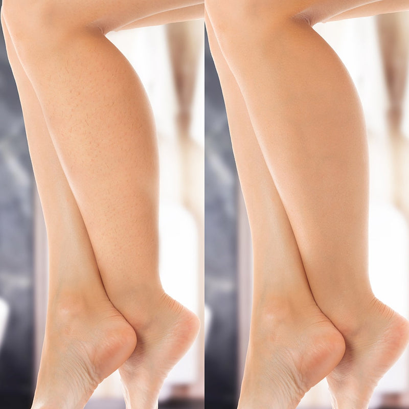 IPL hårfjerning Lumi