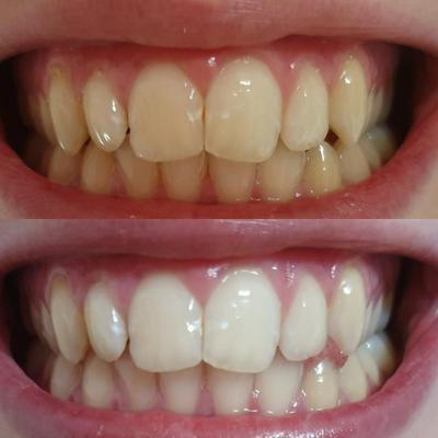 White and yellow teeth. White teeth after teeth whitening with teeth whitening gel. Teeth whitening with teeth whitening.