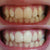 White and yellow teeth. White teeth after teeth whitening with teeth whitening gel. Teeth whitening with teeth whitening.