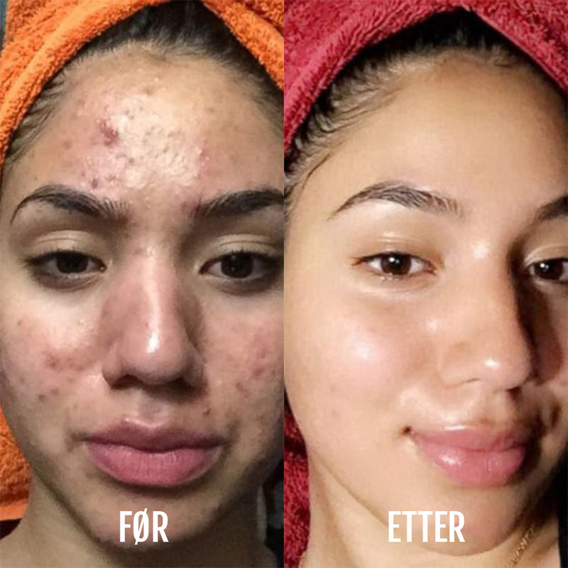 DermaClear lysterapi- og akneenhet