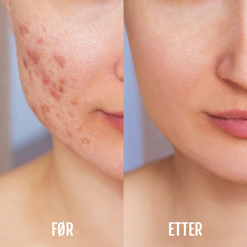 DermaClear lysterapi- og akneenhet