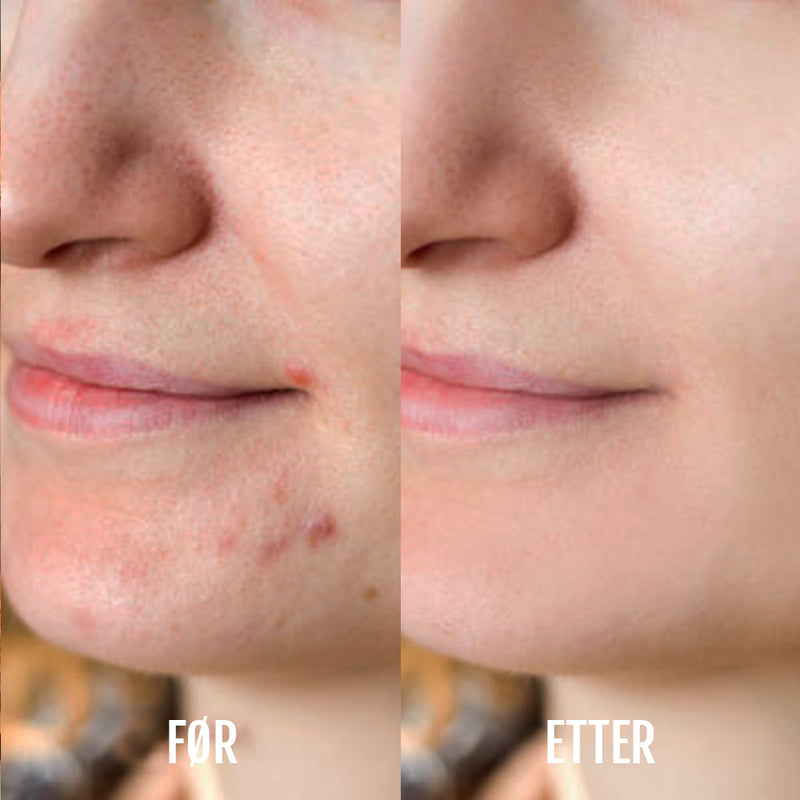 DermaClear lysterapi- og akneenhet