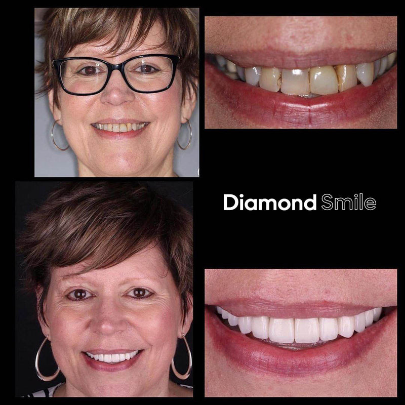 Gammel kvinne med tannbleking før og etter bilder - Teeth Whitening Diamond Smile