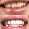 Vorher Nachher Bilder von PAP+ Zahnbleaching Set von Diamond Smile