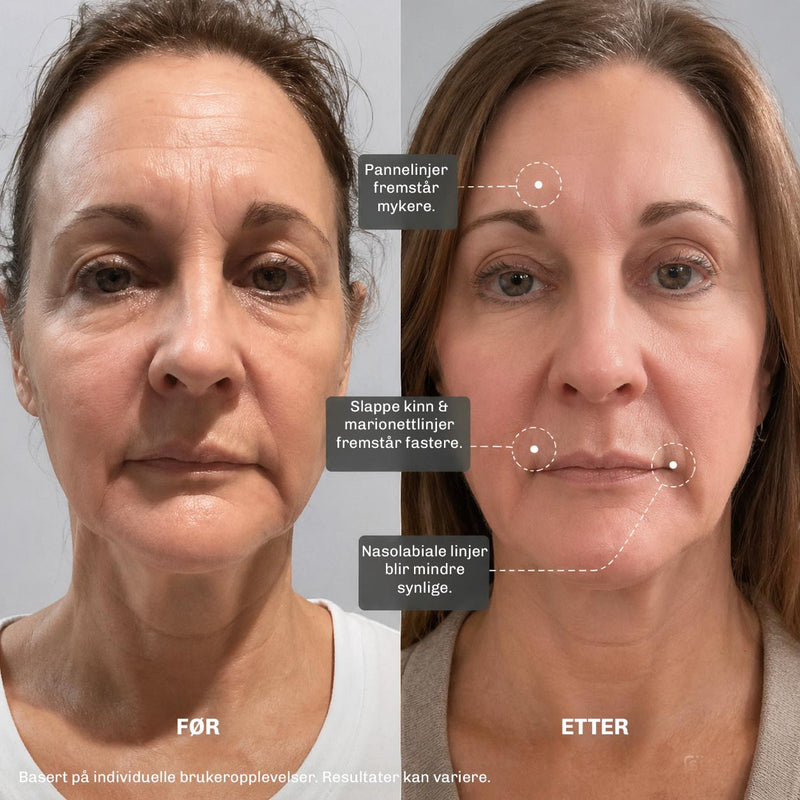 MicroLift Shot