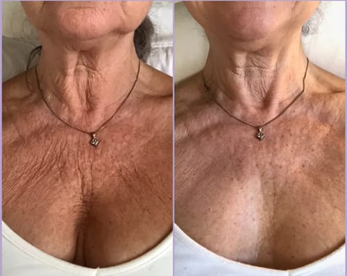 Liftingkrem for halslinjer