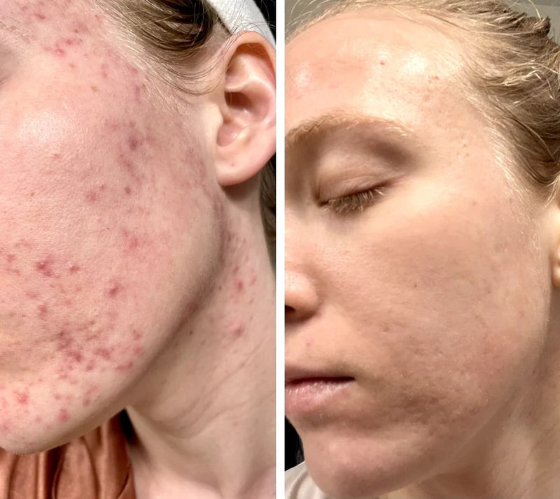 LED-lysterapi maske LUMIWHITE