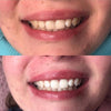 Diamond Smile resultatopplevelse aktivt kull tannbleking strips