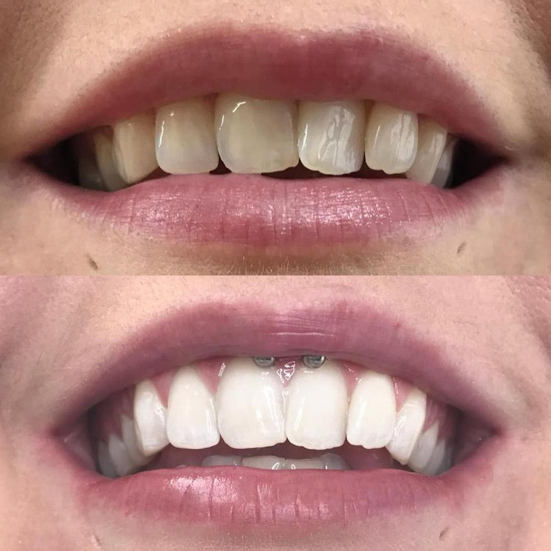 Whitening Munnskyll iD+
