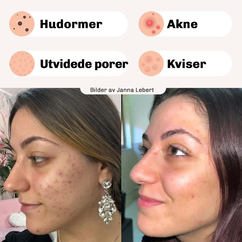 Original Diamond Blackhead Remover Mask