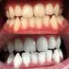 Opplevelse av Diamond Smile Teeth Bleaching Power+ Phone Bleaching Mouthpiece - Munn med før og etter bilde av hvite tenner