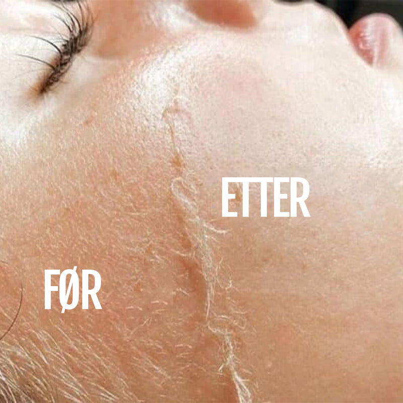 Dermaplaning for presis fjerning av fint ansiktsfjun