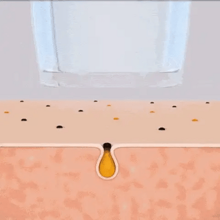 Diamond ClearCam mitesserfjerner med HD-kamera og 20x forstørrelse