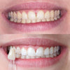 Diamond Smile Tooth Bleaching Power+ Phone Bleaching Mouthpiece - Munn med før- og etterbilde av hvite tenner