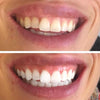 Diamond Smile-resultat Før og etter tannbleking strips for tannbleking hjemme